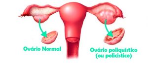 Eu tenho mesmo Síndrome de Ovários Policísticos?