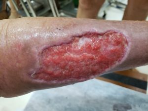 APÓS 25ª SESSÕES DE HIDROZONIOTERAPIA + ÓLEO OZONIZADO (TÓPICO)