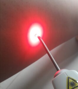 A laserterapia no tratamento de feridas