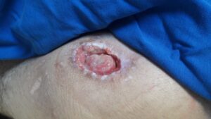 Laserterapia e o tratamento de feridas