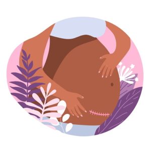 parto_aginal após cesariana